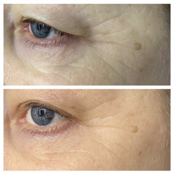 Безоперационная подтяжка нависшего века.