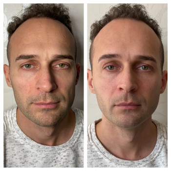 Микроигольчатая мезотерапия.