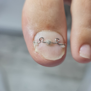 Удаление вросшего ногтя
                    Подолог Руслана Петровна Одесса