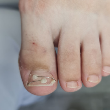 Удаление вросшего ногтя
                    Подолог Руслана Петровна Одесса