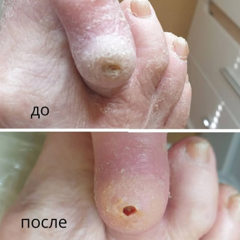 Удаление стержневой мозоли
                    Подолог Руслана Петровна Одеса