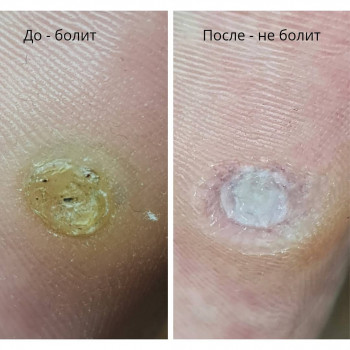 Удаление стержневой мозоли
                    Подолог Руслана Петровна Одеса