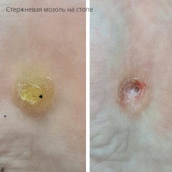 Удаление стержневой мозоли
                    Подолог Руслана Петровна Одеса