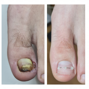 Лечение грибка ногтей и стоп Одесса
                    Подолог Руслана Петровна Одесса