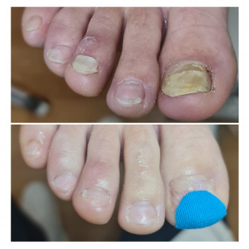 Лечение грибка ногтей и стоп Одесса
                    Подолог Руслана Петровна Одесса