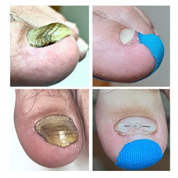 Лечение грибка ногтей и стоп Одесса
                    Подолог Руслана Петровна Одесса