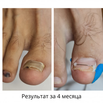 Лечение грибка ногтей и стоп Одесса
                    Подолог Руслана Петровна Одесса