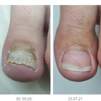 Лечение грибка ногтей и стоп Одесса
                    Подолог Руслана Петровна Одесса