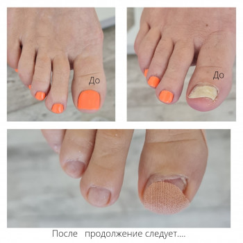 Лечение грибка ногтей и стоп Одесса
                    Подолог Руслана Петровна Одесса