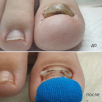 Лечение грибка ногтей и стоп Одесса
                    Подолог Руслана Петровна Одесса