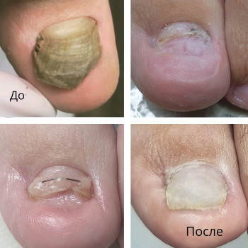 Лечение грибка ногтей и стоп Одесса
                    Подолог Руслана Петровна Одесса