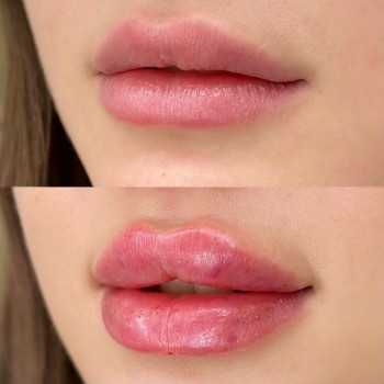 Аугментация. Контурная пластика. Увеличение губ
                    Косметолог Диана Киев