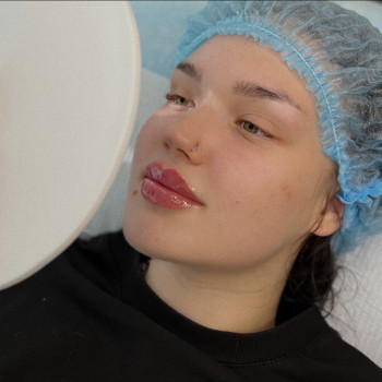 Аугментация. Контурная пластика. Увеличение губ
                    Косметолог Диана Киев