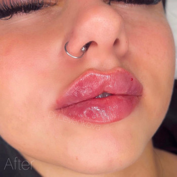 Аугментация. Контурная пластика. Увеличение губ
                    Косметолог Диана Киев