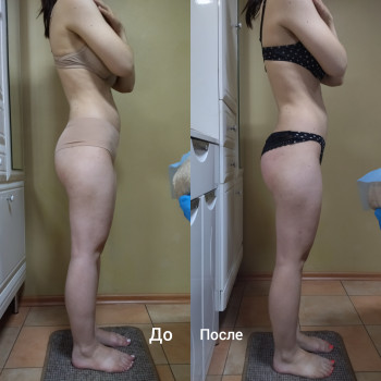 Антицеллюлитный массаж