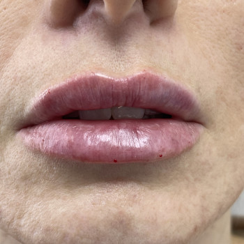 Аугментація губ( відразу після процедури) natural lips