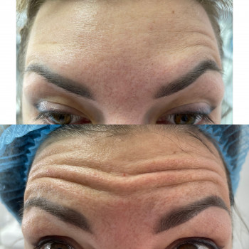 Ботулінотерапія
                    Косметолог Лілія Ровно