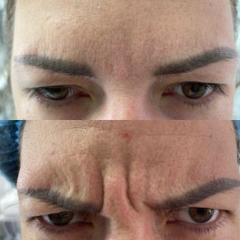 Ботулінотерапія
                    Косметолог Лілія Ровно