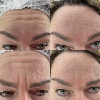 Ботулінотерапія
                    Косметолог Лілія Ровно