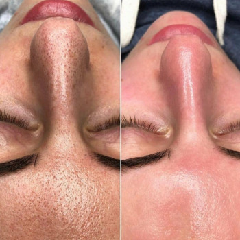 Пилинг PRX 33
                    Врач-косметолог Юлия Харьков