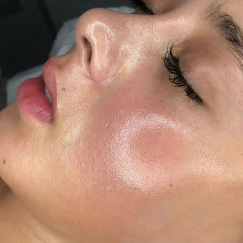 Пилинг PRX 33
                    Врач-косметолог Юлия Харьков