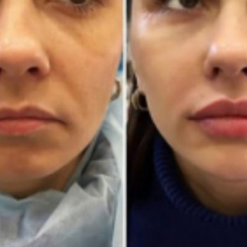 Збільшення скул. 
Одразу свіжий вигляд.
И ліфтинг овалу об