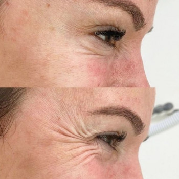  #Ботокс
Навколо очей.