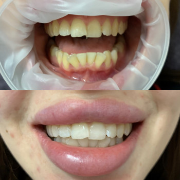 Косметичне відбілювання зубів
                    Масажист Марина Київ