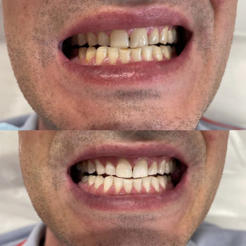 Косметичне відбілювання зубів
                    Масажист Марина Київ