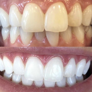 Косметичне відбілювання зубів
                    Масажист Марина Київ