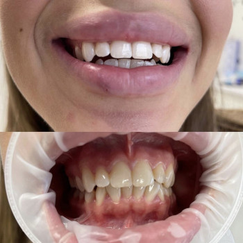 Косметичне відбілювання зубів
                    Масажист Марина Київ