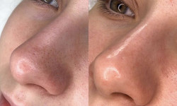 Ферментотерапія Салон краси Sweet Skin Київ