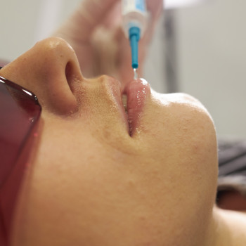 Лазерна Біоревіталізація Vitalaser
                    Косметологический центр Skin Studio Beauty FULL Львов