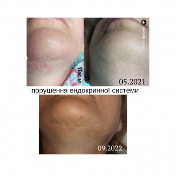 Електроепіляція обличчя - 12 грн / 1хв
                    Косметолог Юлія Киев