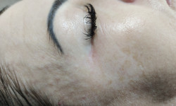 Карбоксітерапія Косметологічний центр Beauty clinic Dr.Pelikh Хмельницький