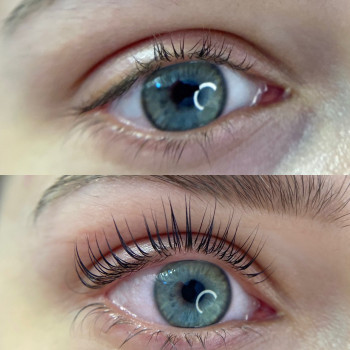 Ботокс вій ДО / ПІСЛЯ