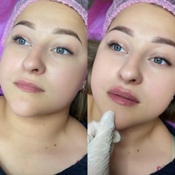 Збільшення губ