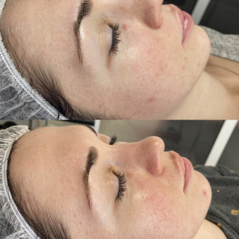 1 процедура пілінгу Prx-T33