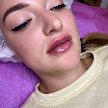 Аугментація губ