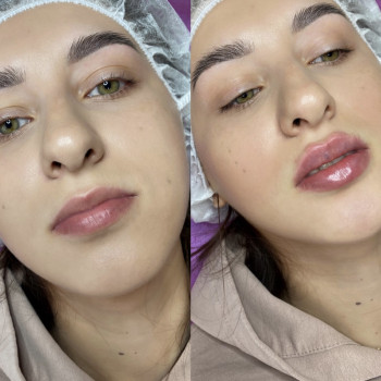 Аугментація губ