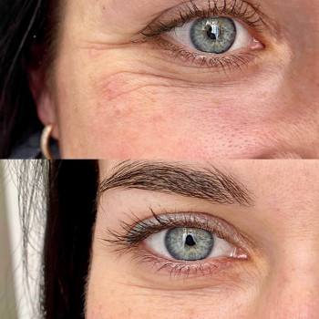 Ботулінотерапія