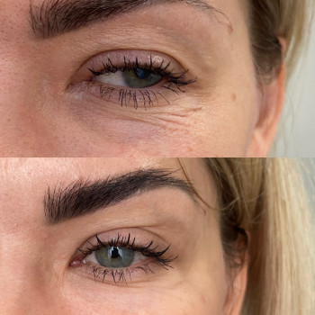 Ботулінотерапія