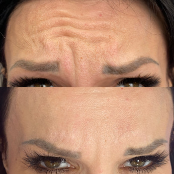 Ботулінотерапія