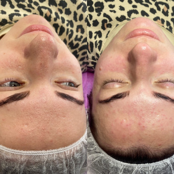 Чистка обличчя