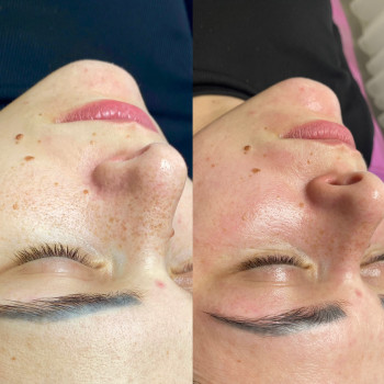 Систка обличчя