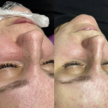 Чистка обличчя+пілінг по типу шкіри