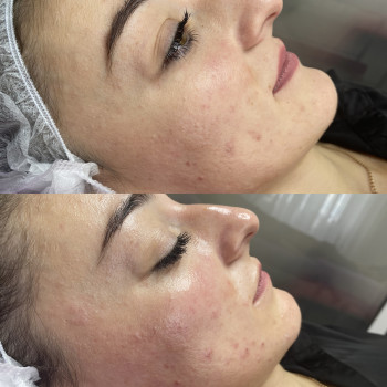 Чистка обличчя+пілінг