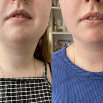 Ліполітики-це зменшення об‘ємів жирової клітковини на підбор