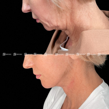 підтяжка нижньої третини обличчя
Вид знеболення: загальний 