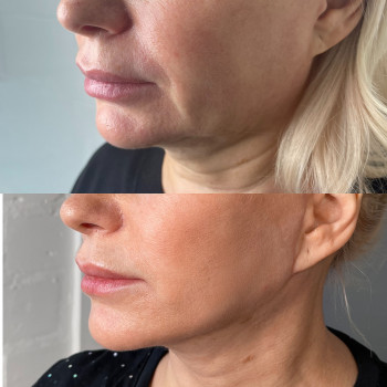 Кругова підтяжка обличчя + підтяжка шиї 
Вид знеболення: за